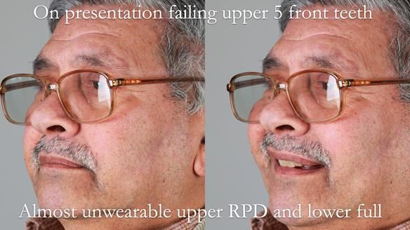 Finlay's Newsletter 62 provision of extractions and metal based complete dentures for Rafique