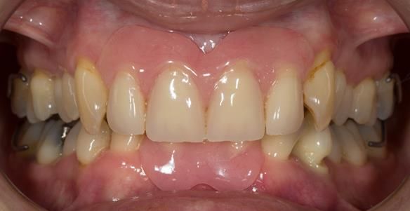  Figure 50 Relined immediate dentures 1 month after extractions
