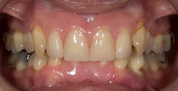 Figure 50 Relined immediate dentures 1 month after extractions