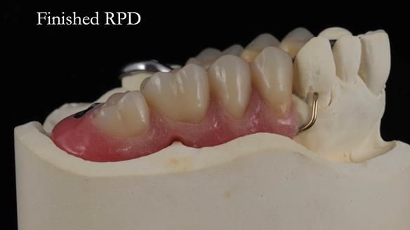 Finlay's Newsletter 60 Sylvia's upper Kennedy Class 2 Mod 1 metal based upper RPD