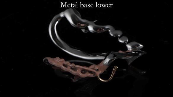 Newsletter 54 case presentation upper complete denture and lower Scandinavian designed hygienic partial denture for David