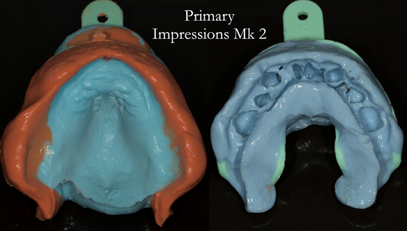 Figure 57 The start of the definitive upper denture (Mk 2). Primary impressions. Upper in 2 part Zhermack alginate lower Dentsply Blueprint creme alginate