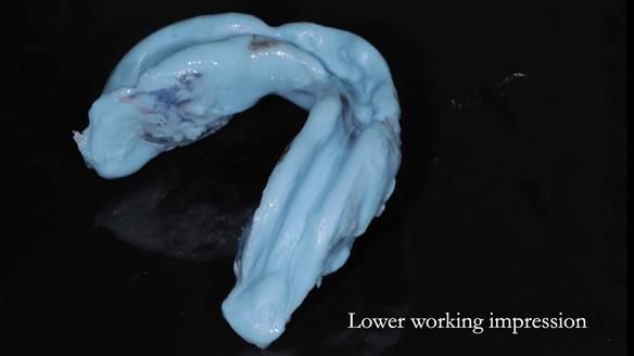 Newsletter 82 Mary - A complete upper and a one-tooth gasket denture