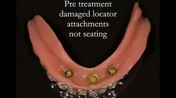 Denture not seating properly on the implants - damaging the Locator inserts