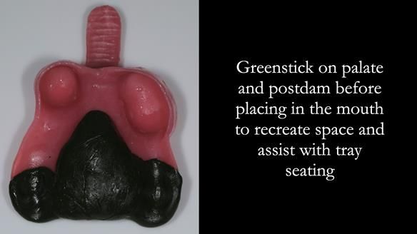 Finlay's Newsletter 59 Ultra hard partial dentures made for Gill