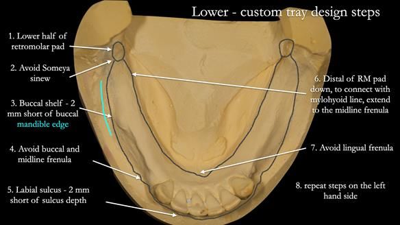 Newsletter 52 Managing Jo’s failing dentition with extractions and Mk 1/Mk 2 complete upper dentures and lower partial dentures FULL PROTOCOL