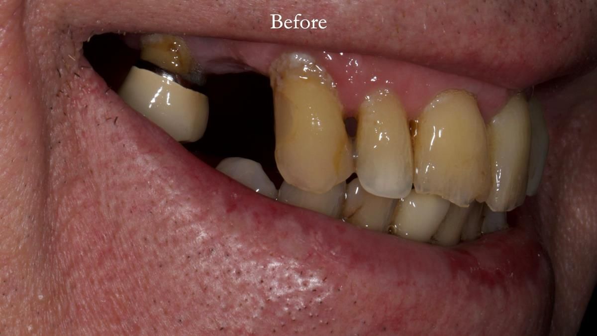 Newsletter 89 – Simon: A Challenging Kennedy Class II Division 1 Upper CoCr Partial Denture with a High Smile Line
