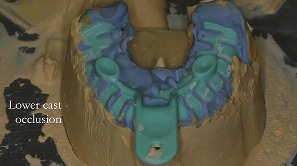 Newsletter 51 Managing Anne’s failing dentition with distal extension base RPD/Splint FULL PROTOCOL