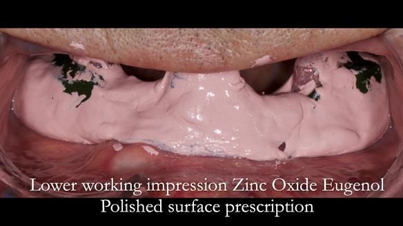 Newsletter 50 Special edition Complete Dentures FULL PROTOCOL