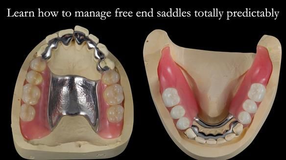 Finlay's Newsletter 59 Ultra hard partial dentures made for Gill