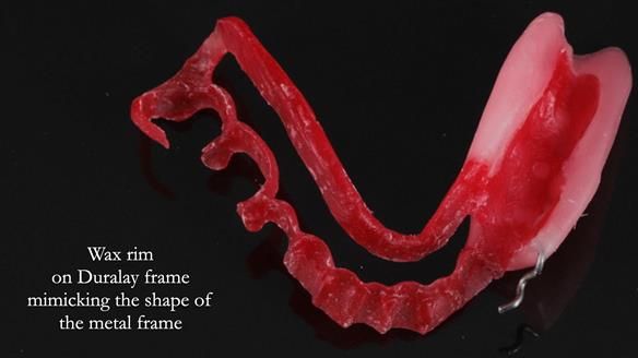 Finlay's Newsletter 61 provision of a lower unilateral free end saddle metal based partial denture for Joyce