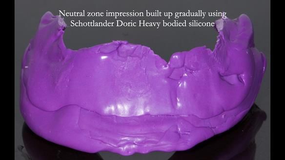 Newsletter 83: Sheila’s Complete Denture Success