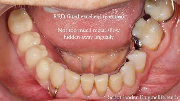 Finlay's Newsletter 61 provision of a lower unilateral free end saddle metal based partial denture for Joyce