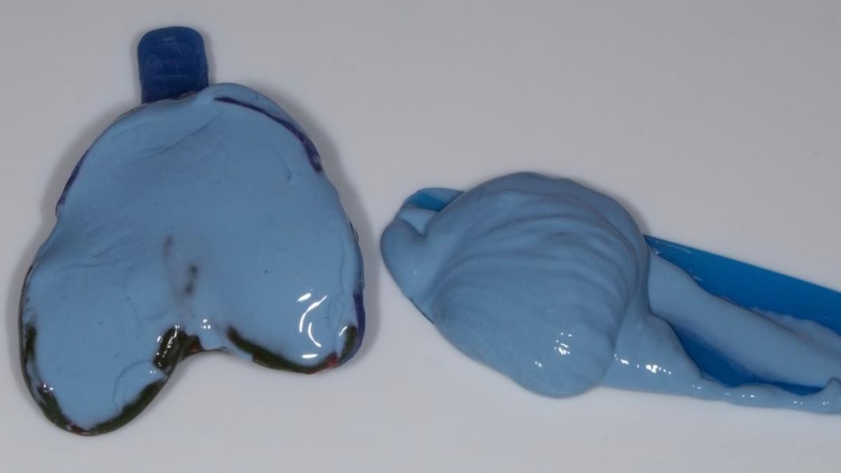 Newsletter 89 – Simon: A Challenging Kennedy Class II Division 1 Upper CoCr Partial Denture with a High Smile Line