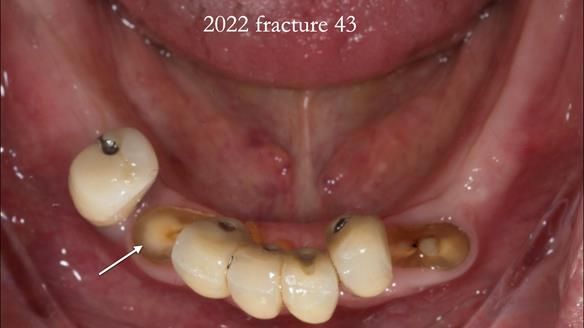 Ken – going downhill, first class