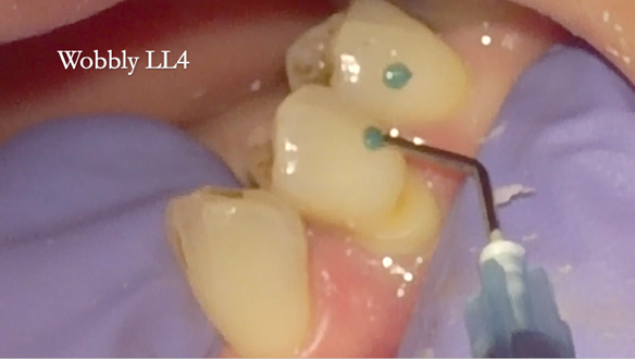 Figure 59 Grade 2 mobile LR4 would move in the impression. To avoid this it was temporarily stabilised with a composite splint