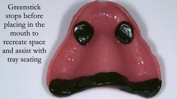 Newsletter 54 case presentation upper complete denture and lower Scandinavian designed hygienic partial denture for David