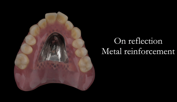 Figure 109 If I was to treat Anne again I would provide the definitive denture (Mk 2) with metal reinforcement as per this image - because if the denture breaks - "A fractured denture is much easier to repair than the patient's broken confidence" - Quote 