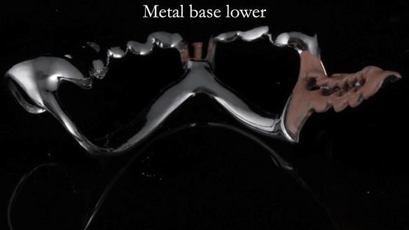 Newsletter 54 case presentation upper complete denture and lower Scandinavian designed hygienic partial denture for David