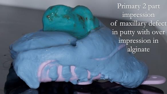 Upper metal base partial denture/occlusal stabilisation splint/obturator - full protocol