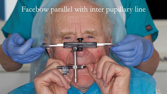 Complete denture Class II div 2 deep overbite Newsletter 39