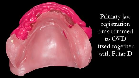 Newsletter 52 Managing Jo’s failing dentition with extractions and Mk 1/Mk 2 complete upper dentures and lower partial dentures FULL PROTOCOL