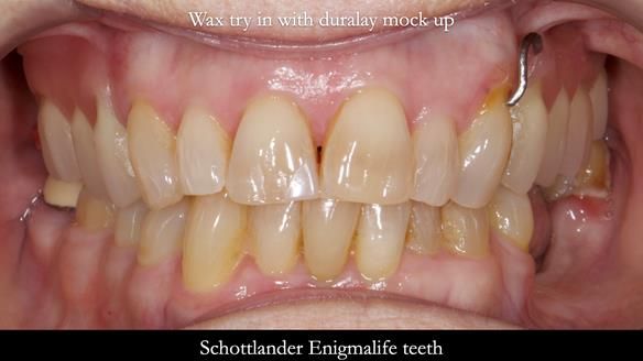 Finlay's Newsletter 60 Sylvia's upper Kennedy Class 2 Mod 1 metal based upper RPD