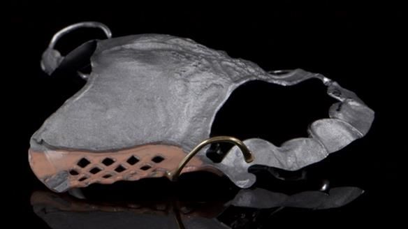 Finlay's Newsletter 64 case study - provision of a Kennedy class 2 metal based Scandinavian RPD for Ian