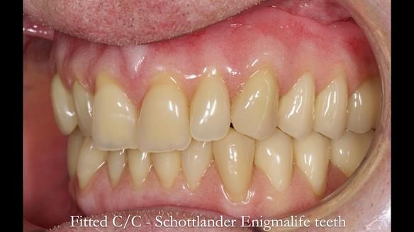Complete denture Class II div 2 deep overbite Newsletter 39