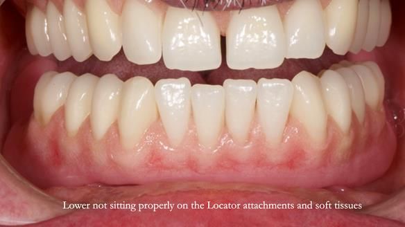 Newsletter 78: What do Clark Gable and a Locator® overdenture have in common?