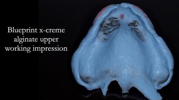 Newsletter 54 case presentation upper complete denture and lower Scandinavian designed hygienic partial denture for David