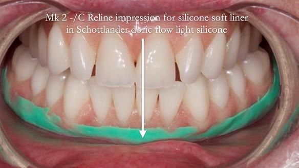 Replacing Madeline’s Complete denture FULL PROTOCOL