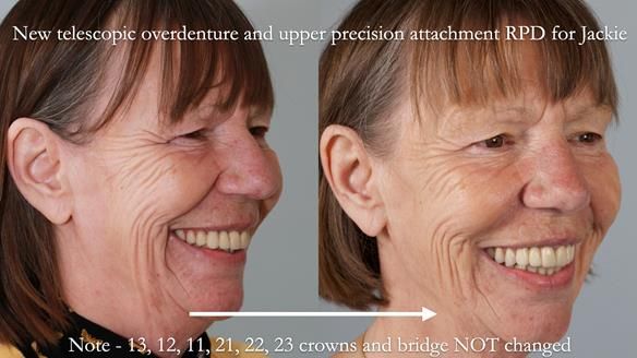 Newsletter 76: Jackie’s case – Telescopic overdenture & precision RPD (the tricky truth!)