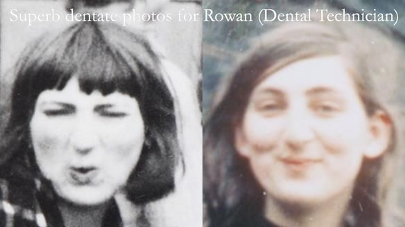 Newsletter 55 Provision of metal based partial dentures for Zephyrine with a repaired cleft lip and palate