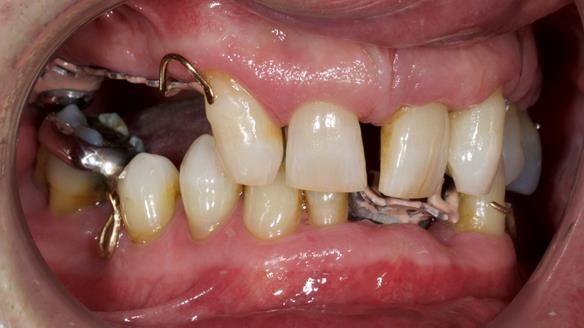 Newsletter 86 Peter the Architect — precision removable partial dentures case study