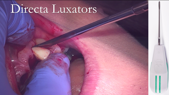 Figure 24 Extraction of the upper and lower incisors using Directa Luxators