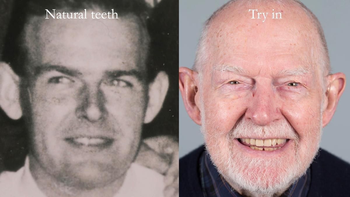 Newsletter 87 – Father Peter: A Partial Denture that needed Minor Miracle