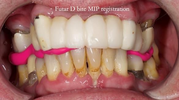 Newsletter 77: Jeremy’s case – immediate complete upper denture