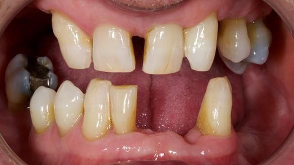 Newsletter 86 Peter the Architect — precision removable partial dentures case study