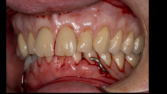 Figure 47 Visit 2 fitting of Mk 1 upper complete and lower partial immediate dentures