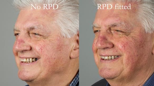 Finlay's Newsletter 64 case study - provision of a Kennedy class 2 metal based Scandinavian RPD for Ian