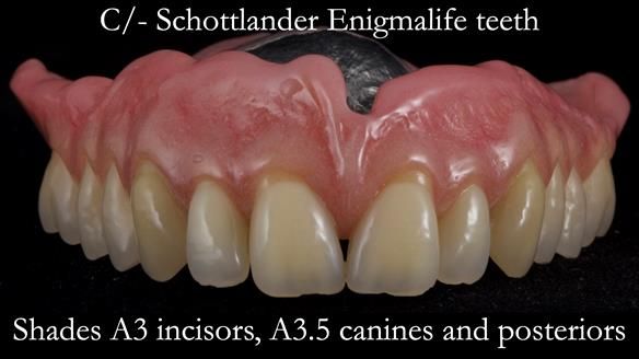Newsletter 54 case presentation upper complete denture and lower Scandinavian designed hygienic partial denture for David