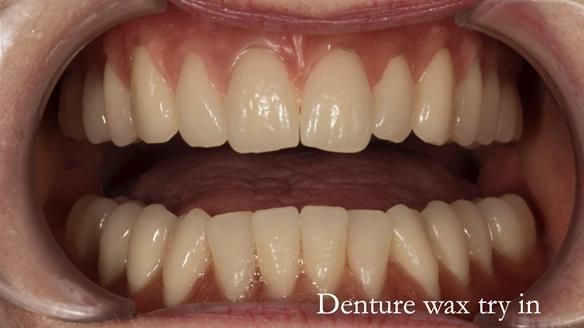 Newsletter 75: Marion’s case - Step-by-step complete denture workflow