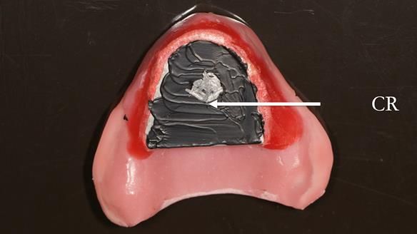 Newsletter 54 case presentation upper complete denture and lower Scandinavian designed hygienic partial denture for David