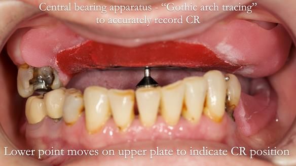 Newsletter 52 Managing Jo’s failing dentition with extractions and Mk 1/Mk 2 complete upper dentures and lower partial dentures FULL PROTOCOL