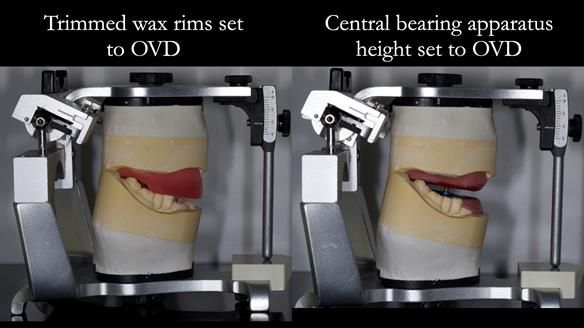 Newsletter 82 Mary - A complete upper and a one-tooth gasket denture