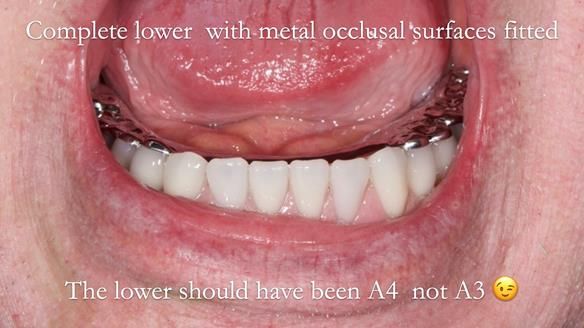 Newsletter 44 - extreme removable prosthodontics – engineering a super-strong and ultra-thin over denture