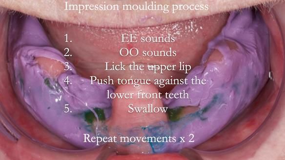 Replacing Madeline’s Complete denture FULL PROTOCOL
