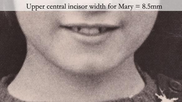 If a frontal dentate photograph of the patient is available then Dr John Besfords tooth size calculation formula can be used to calculate the size of the prosthetic teeth.