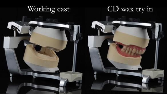 Finlay's Newsletter 62 provision of extractions and metal based complete dentures for Rafique